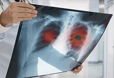 Erkeklerde en sık akciğer kadınlarda meme kanseri görülüyor