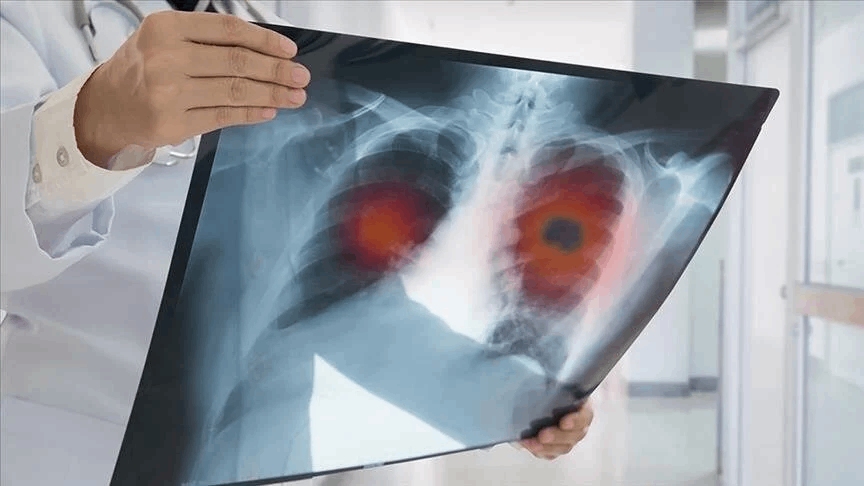 Erkeklerde en sık akciğer kadınlarda meme kanseri görülüyor